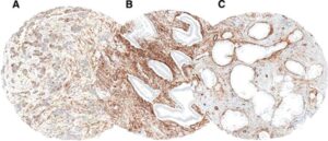 CD BioSciences Announces Cytoskeleton-Targeted Tumor Marker Development Service for Cancer Diagnosis